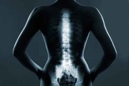 Rückenwirbelsäule im Röntgenbild