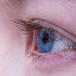 Augenlidstraffung mit Plasma Technologie